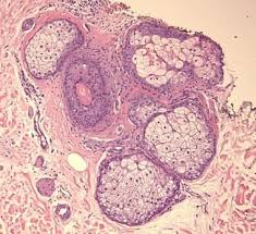 Image result for Sebaceous Gland