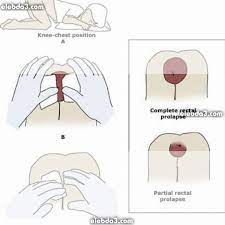 مقال السقوط و الهبوط الشرجي تدلي الشرج و المستقيم امراض جهاز الهضم عند الأطفال