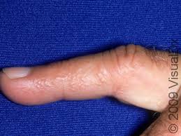 Image result for dyshidrosis