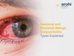 Image result for Vernal Conjunctivitis