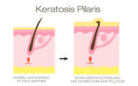 It looks and feels like rough, small bumps. What Is Keratosis Pilaris