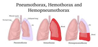 This damages or injury can be during an accident, bullet or stab injury as mentioned in traumatic pneumothorax. Pneumothorax In The Adult Patient Nursing Ceus