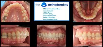 How is invisalign treatment different than other teeth straightening options? Invisalign Before And After Photos Australia 2019
