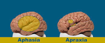 Image result for Apraxia