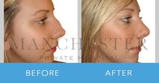 Rhinoplasty is a surgery that changes the shape of the nose. Rhinoplasty Manchester Nose Correction Surgery Nose Job Manchester