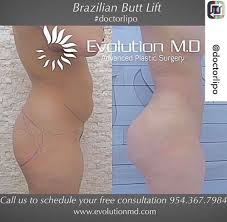 Repost From Doctorlipo Incredible Transformation Before And After Bbl At Evolutionmd By Doctorlipo Antes Y Body Surgery The Incredibles Beauty Secrets