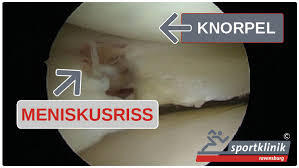 Gestern hatte ich eine kernspinntomographie und es kam herraus das ich ein reptum ded vorderen kreuzbandes, einen erguß, einen anriß des innenbandes und des meniskuses. Meniskusriss Meniskusschaden Ursachen Symptome Behandlung Sportklinik Ravensburg