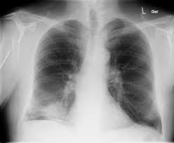 In this mayo clinic radio health minute, dr. Popcorn Lung Symptoms Mayo Clinic