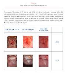 Squamous cell cervical cancer is the most common. Automated Visual Evaluation Ave For Cervical Cancer Screening