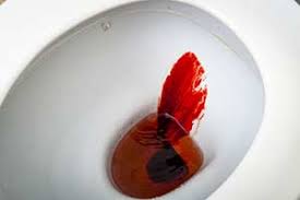 Die behandlung von blut im stuhl richtet sich nach der zugrundeliegenden ursache. Blut Im Stuhl Melana Hamatochezie Symtom Ursachen Diagnose Behandlung Krank De