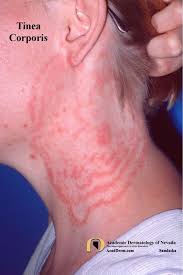 Image result for ringworm