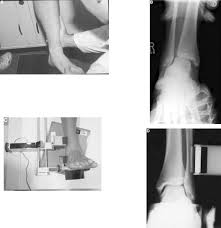 Image result for Ankle External Rotation Test