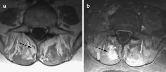 The supraspinatus, infraspinatus and teres minor muscles and tendons are shown. Disorders Of Paravertebral Lumbar Muscles From Pathology To Cross Sectional Imaging Springerlink