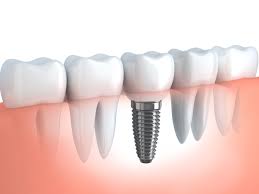Qué son los implantes dentales? | Tu higiene dental