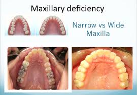Soroush Zaghi Md Highly Specialized Snoring And Sleep Apnea Surgeon Tongue Tie Functional Ankyloglossia Tongue Tie Sleep Apnea Nasal Obstruction