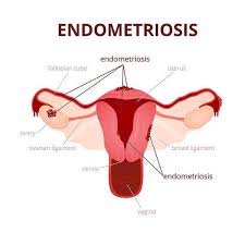 Marcello ceccaroni, direttore di ginecologia e ostetricia. Endometriosi Sintomi Cause Persone A Rischio Rimedi Ed Alimentazione Greenme