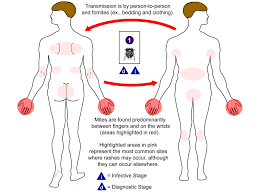 Image result for scabies symptoms