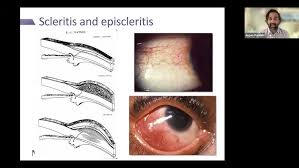 Image result for Scleritis