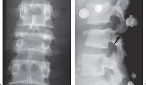 Maybe you would like to learn more about one of these? Vertebral Injuries Detection And Implications Radiology Key
