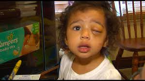 Children often get sick or have bumps or bruises that might mask the early signs of cancer. Only On 11 Toledo Child Battles Eye Cancer Wtol Com