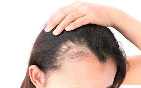 Possible causes of hair loss include androgenetic alopecia, pregnancy, and telogen effluvium. What S Causing Your Hair Loss University Health News