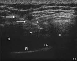 Image result for Intrapleural Anesthesia