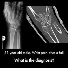 Image result for Scapholunate Dislocation