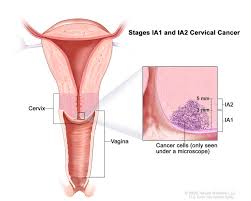 Cancer cells in the bone can sometimes travel to the lungs and grow there. Cervical Cancer Pictures Of Cervical Cancer Stages Symptoms Diagnosis Cleveland H University Hospitals