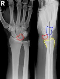 Image result for Lunate Dislocation