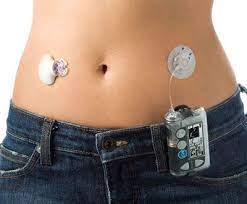 Revolutionizing Monitor For Diabetics Insulin Pump Medtronic Insulin Pump Insulin Pump Accessories