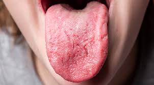 Perubahan yang bersifat alami tersebut umumnya tidak berbahaya dan tidak perlu penanganan khusus. Penyakit Candidiasis Gejala Penyebab Dan Cara Mengobati Halodoc Com