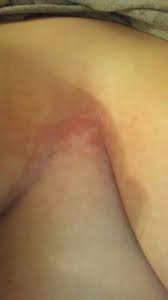 It is mostly a form of irritant dermatitis and is called intertrigo here are the top 10 ways to get rid of a rash under your breasts. Rash Between Boobs Tmi Glow Community