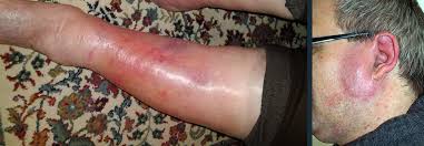 Image result for erysipel photos)