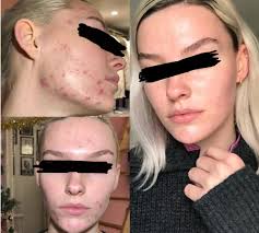 Though people take vitamin c supplements as tablets, the skin healing properties of vitamin c are best utilized by using topical forms of the vitamin. 20 Most Incredible Before And After Photos Of Redditors And The Routines That Transformed Their Skin Daily Vanity