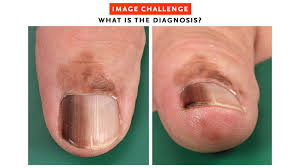 Image result for Acral lentiginous melanoma nail