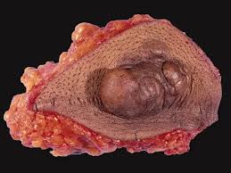 Image result for Dermatofibrosarcoma Protuberans