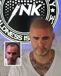 Expert Scalp Micropigmentation in NYC