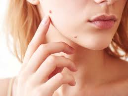 Do moles come from sun exposure? no matter your age, too much sun exposure or just one bad sunburn can cause trouble for your skin. 5 Ways To Get Rid Of Moles At Home The Times Of India