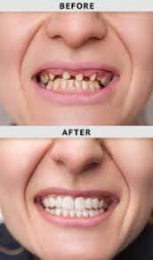 This kind of work is sometimes called a 'smile makeover' or 'hollywood smile'. What Is The Importance Of Cosmetic Dentistry