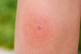 Boala lyme (borelioza) este o boal infecioas cu. Dureri Articulare DupÄƒ MuÈ™cÄƒturÄƒ Dureri Articulare Datorate Leziunilor Coloanei Vertebrale