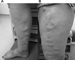 Varicose veins usually cause few symptoms. Varicose Veins Circulation