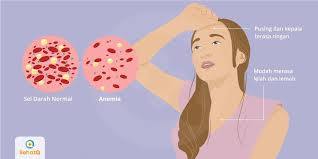 Anemia Gejala Diagnosis Pengobatan