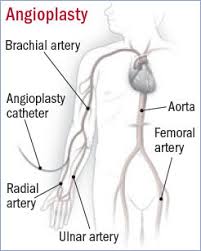 There are various types of for example, percutaneous transluminal angioplasty (pta) means that the vessel is entered through the skin (percutaneous) and that the catheter is moved into. Angioplasty And Stenting Through The Arm Harvard Health