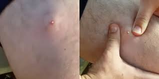 The condition is most prevalent among people who have coarse or curly hair. This Knee Pimple Popping Video Is Perfect For Pimple Poppers