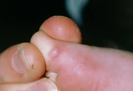 Traitement contre le pieds mains bouche. Maladie Pieds Mains Bouche Maladies Infectieuses Edition Professionnelle Du Manuel Msd