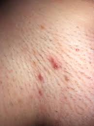 Ingrown pubic hairs are common for women who groom around their vagina and bikini area. I M The Queen Of Ingrown Hairs Popping