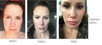 Non-Surgical Cheek Enhancement by Visage Academy