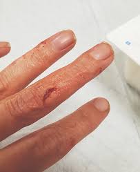 Image result for Dog Bite