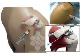 Image result for Subacromial Space Injection