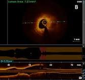 Überblick zur optischen Kohärenztomographie (OCT) bei der ...